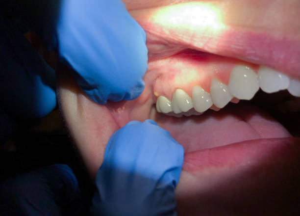 Best Emergency Root Canal Therapy in North Granby, CT
